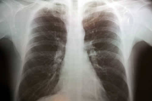 Ipertrasparenza enfisematosa polmoni