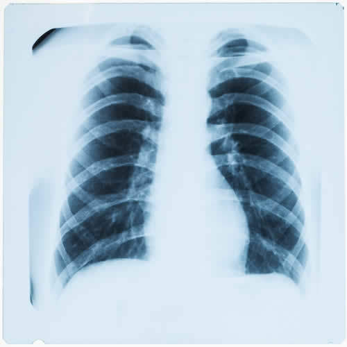 Ispessimenti pleurici e placche pleuriche nelle radiografie del torace