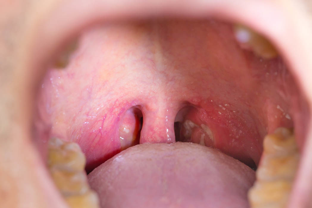 papilloma vírus ugola pikkelyes papilloma a szájban