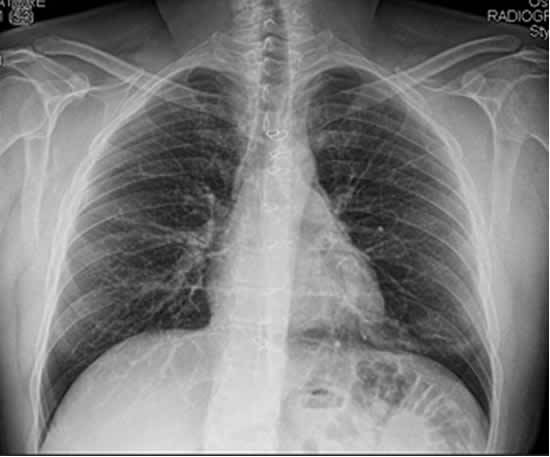 Disventilazione Strie Peribronchiete - Pneumologo ballor