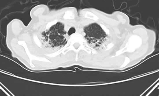 Fibrosi Apici Bronchiectasie Torace