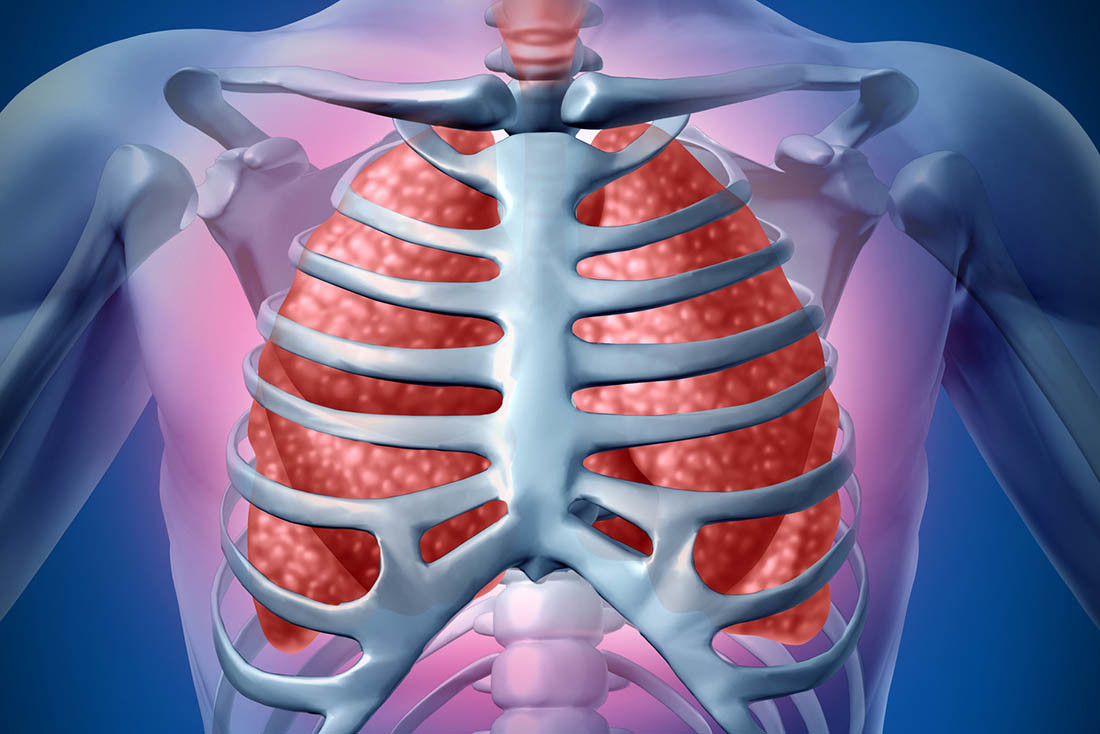 Infezione polmonare in 3D - Gabbia toracica pleurite versamento pleurico