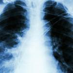 polmonite con insufficienza respiratoria