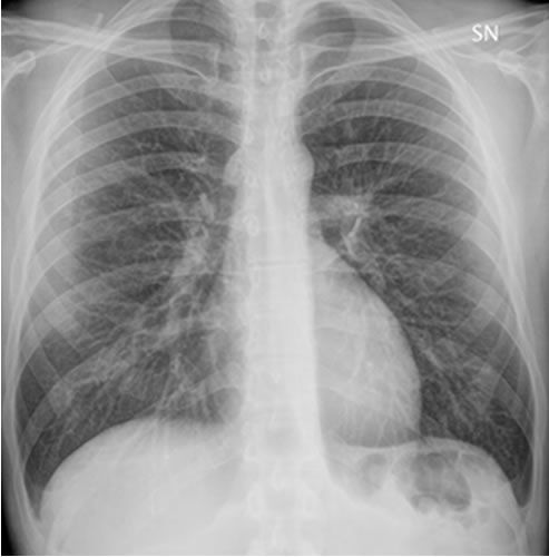 Rinforzo Del Disegno Bronchiale Nella Radiografia Del Torace