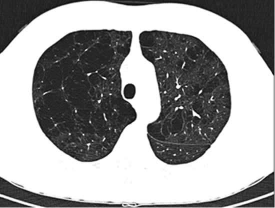 TAC Torace (HRCT) in paziente con diffuso enfisemapolmonare bolloso conseguente a deficit di α1-AT (DAAT)