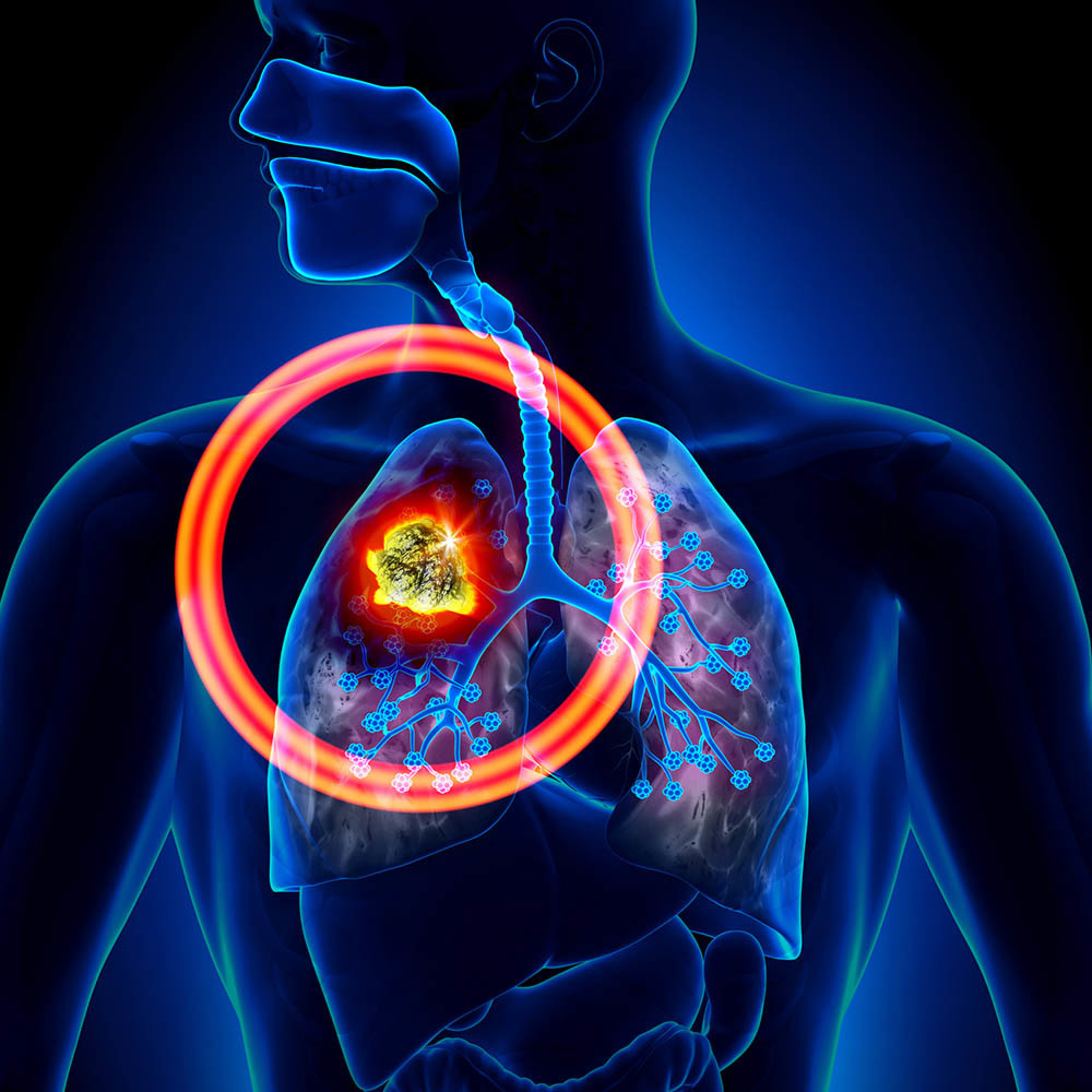 Tumore maligno al polmone - Render 3D