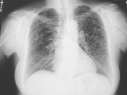 Diagnosi Istiocitosi X Polmonare - Lastra 01