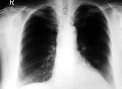 Radiografia Polmoni