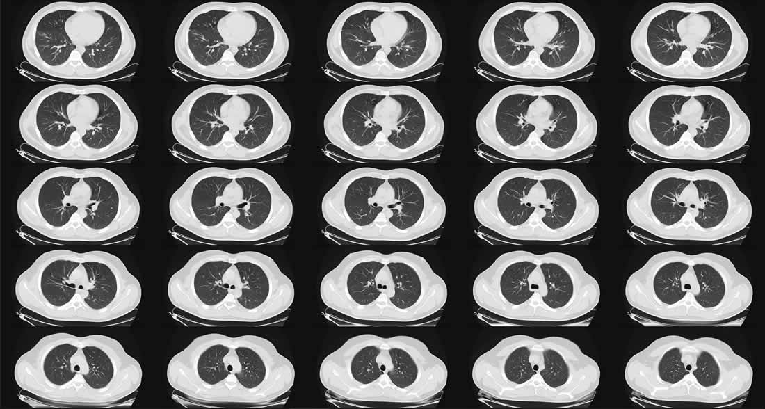 tomografia polmonare