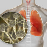 micosi polmonare da aspergillo invasivo