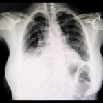 radiografia donna con versamento pleurico