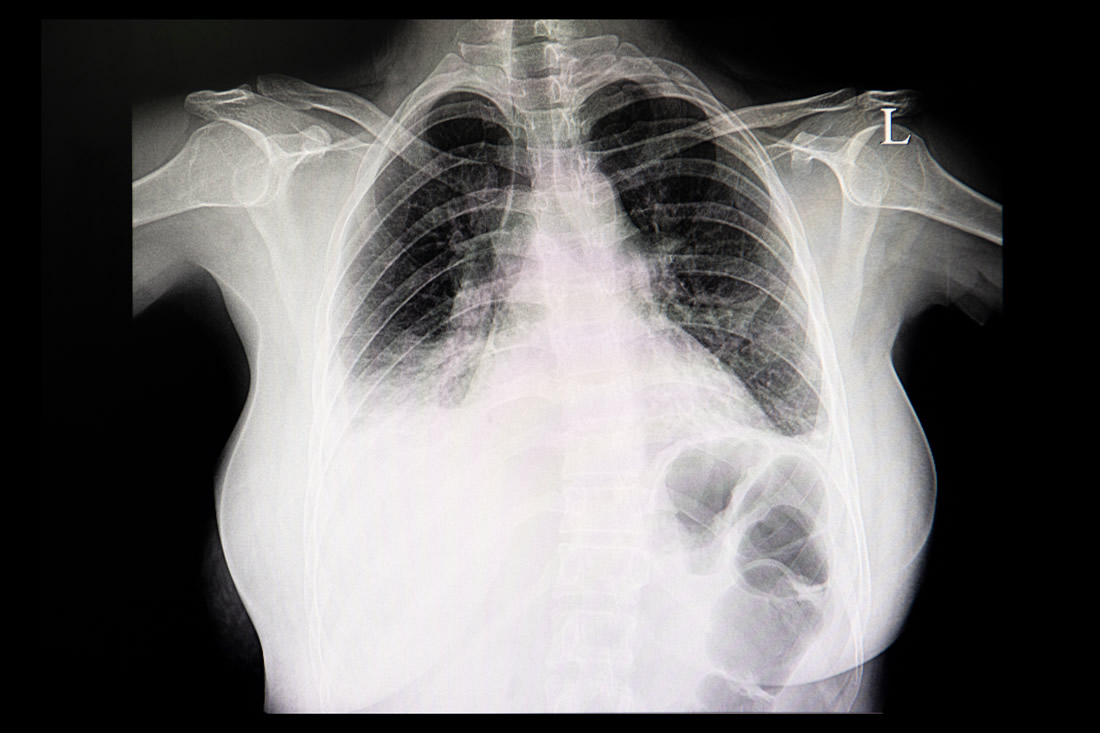 radiografia donna con versamento pleurico